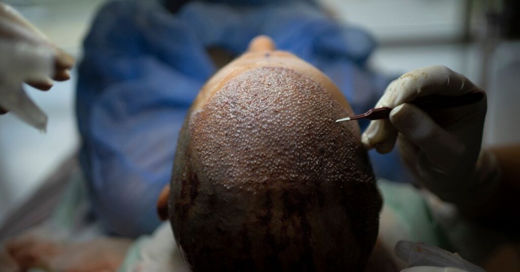 How Turkey Revolutionized the Hair Transplant Sector